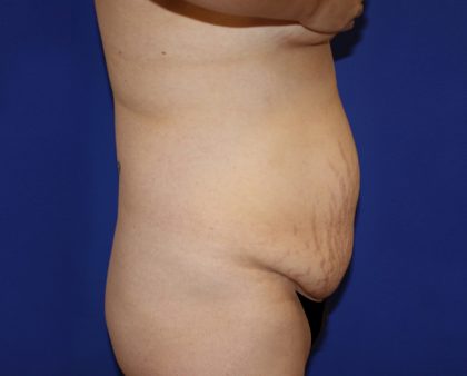 Tummy Tuck Before & After Patient #463