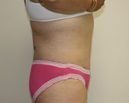 Tummy Tuck Before & After Patient #463