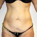 Tummy Tuck Before & After Patient #449