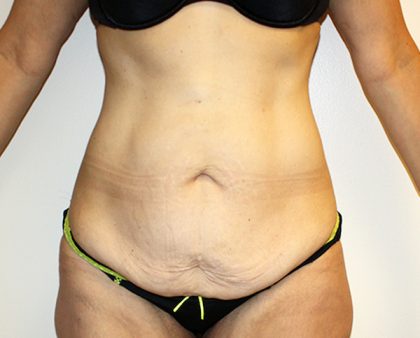 Tummy Tuck Before & After Patient #449