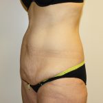 Tummy Tuck Before & After Patient #449