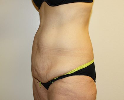 Tummy Tuck Before & After Patient #449