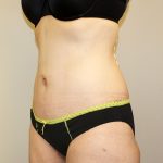 Tummy Tuck Before & After Patient #449