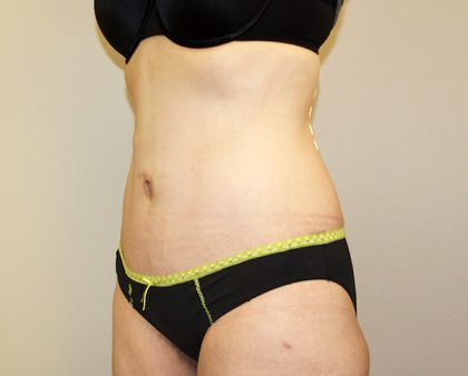 Tummy Tuck Before & After Patient #449