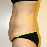 Tummy Tuck Before & After Patient #449