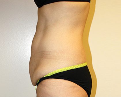 Tummy Tuck Before & After Patient #449