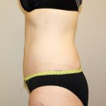 Tummy Tuck Before & After Patient #449