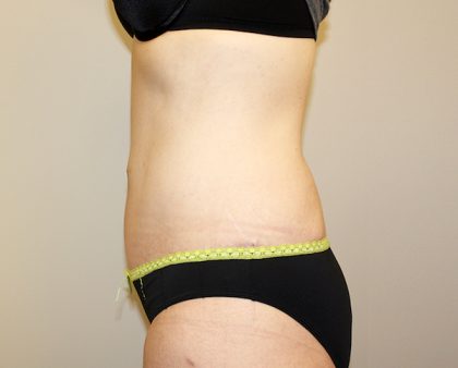 Tummy Tuck Before & After Patient #449