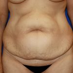 Tummy Tuck Before & After Patient #456