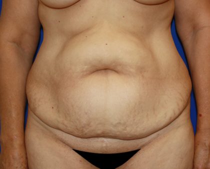 Tummy Tuck Before & After Patient #456