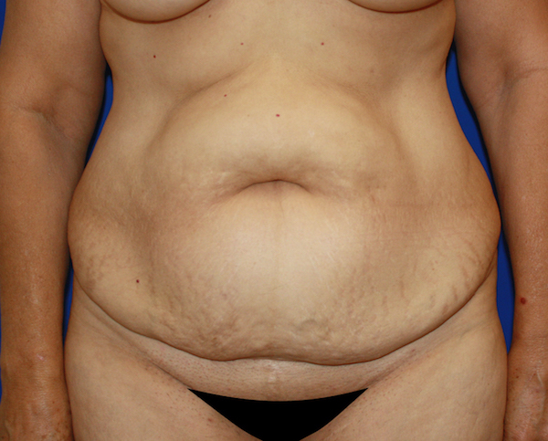 Major Weight Loss Tummy Tuck Before & After Patient #456