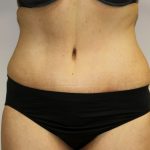 Tummy Tuck Before & After Patient #456