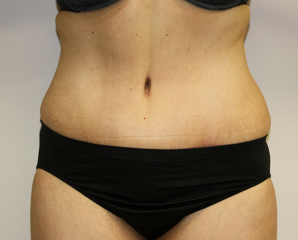 Major Weight Loss Tummy Tuck Before & After Patient #456