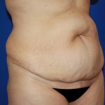 Tummy Tuck Before & After Patient #456