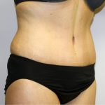 Tummy Tuck Before & After Patient #456