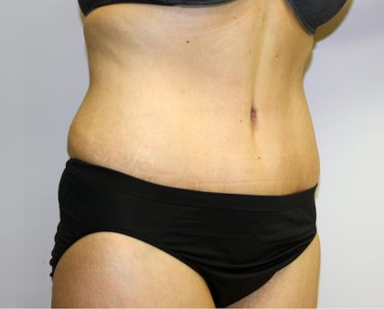 Tummy Tuck Before & After Patient #456