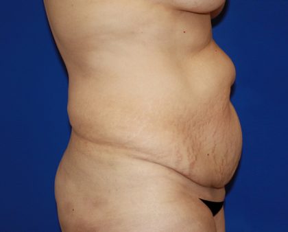 Tummy Tuck Before & After Patient #456