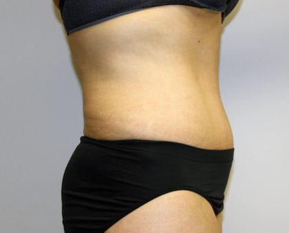 Tummy Tuck Before & After Patient #456