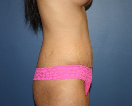 Tummy Tuck Before & After Patient #424