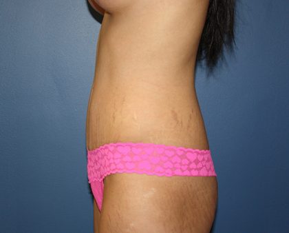 Tummy Tuck Before & After Patient #424