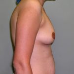 Breast Augmentation Before & After Patient #1660