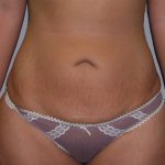 Tummy Tuck Before & After Patient #507