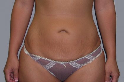 Tummy Tuck Before & After Patient #507