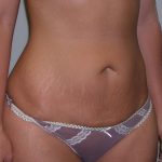 Tummy Tuck Before & After Patient #507