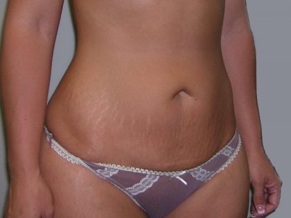 Tummy Tuck Before & After Patient #507