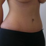 Tummy Tuck Before & After Patient #507