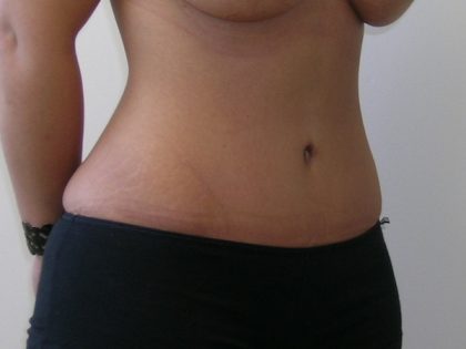 Tummy Tuck Before & After Patient #507