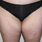 Thigh Lift Before & After Patient #1370