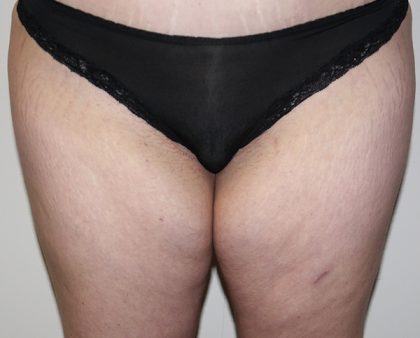 Thigh Lift Before & After Patient #1370