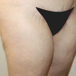 Thigh Lift Before & After Patient #1370