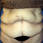 Major Weight Loss Tummy Tuck Before & After Patient #1233