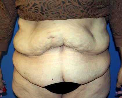 Major Weight Loss Tummy Tuck Before & After Patient #1233
