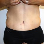 Major Weight Loss Tummy Tuck Before & After Patient #1233