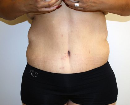 Major Weight Loss Tummy Tuck Before & After Patient #1233