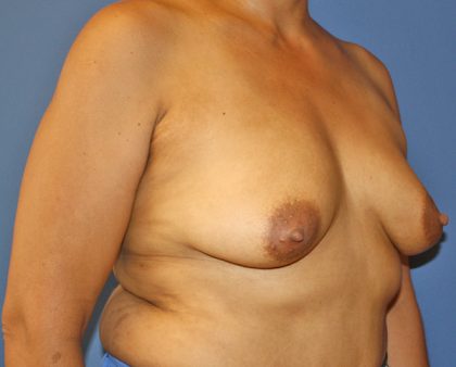 Breast Augmentation Before & After Patient #1446