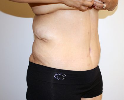 Major Weight Loss Tummy Tuck Before & After Patient #1233