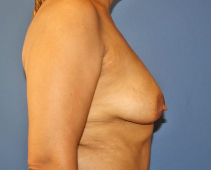 Breast Augmentation Before & After Patient #1446