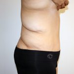 Major Weight Loss Tummy Tuck Before & After Patient #1233