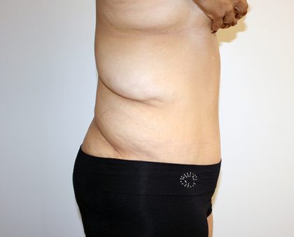 Major Weight Loss Tummy Tuck Before & After Patient #1233