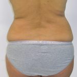 Liposuction Before & After Patient #1107