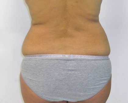 Liposuction Before & After Patient #1107