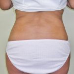 Liposuction Before & After Patient #1107