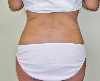 Liposuction Before & After Patient #1107