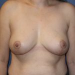 Breast Reduction Before & After Patient #883