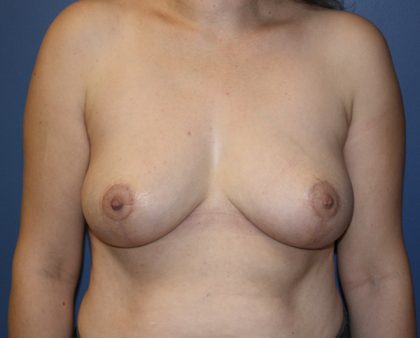 Breast Reduction Before & After Patient #883