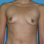 Breast Augmentation Before & After Patient #1416